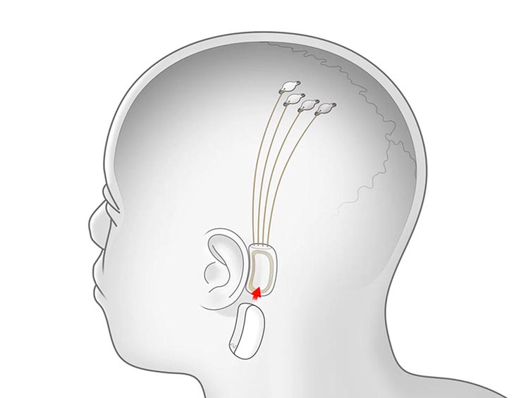 Чіп встановлений за вухом, а електроди підключені до мозку